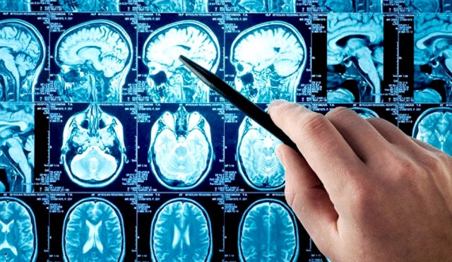 accidente cerebro vascular